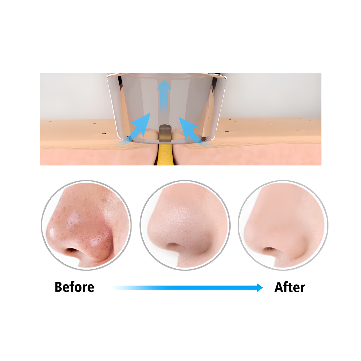 Blackhead Remover Electric Blackhead Vacuum Suction Rechargeable Whitehead Remover Tool Kite Cleanser with 5 Replaceable Heads
